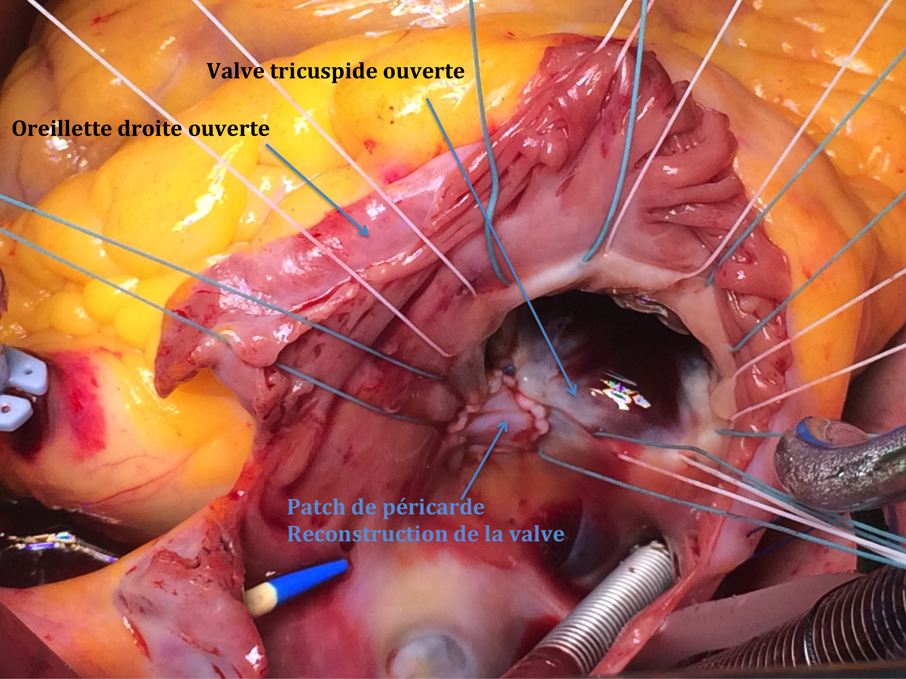 Rupture de l’aorte ascendante avec tamponnade