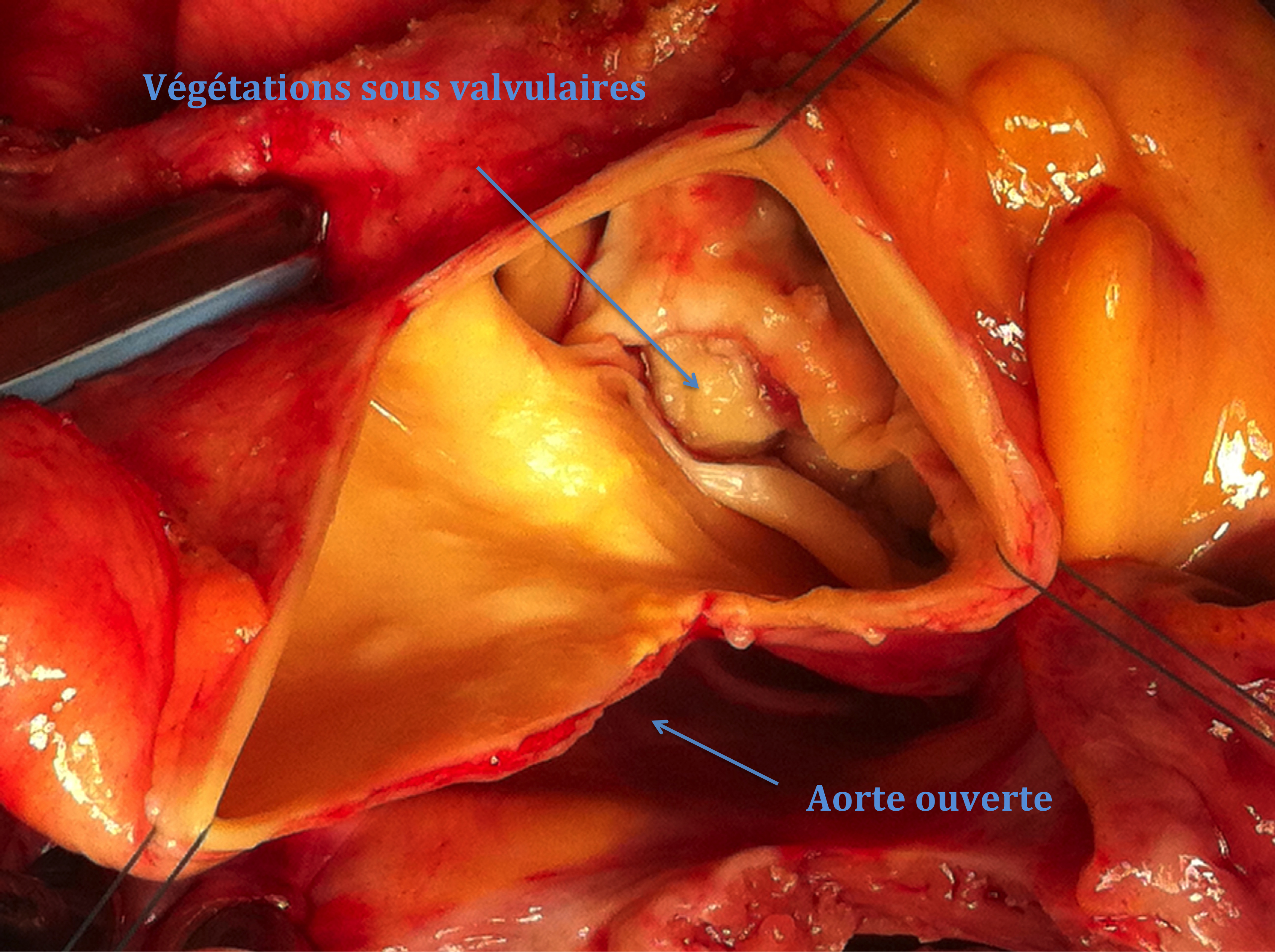Rupture de l’aorte ascendante avec tamponnade