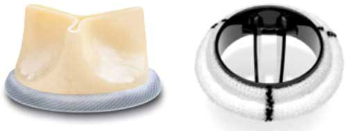 Bioprothèse