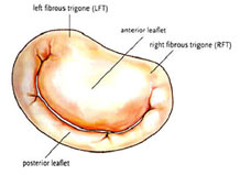 Chirurgie de la valve mitrale