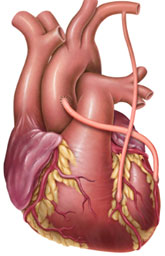 Chirurgie des artères coronaires