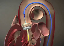 Implantation percutanée de valve aortique (TAVI)