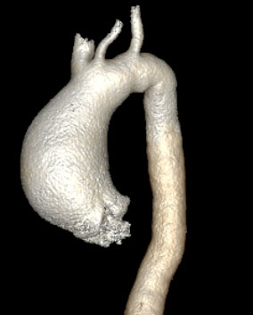 Scanner 3D d’un anévrisme aortique