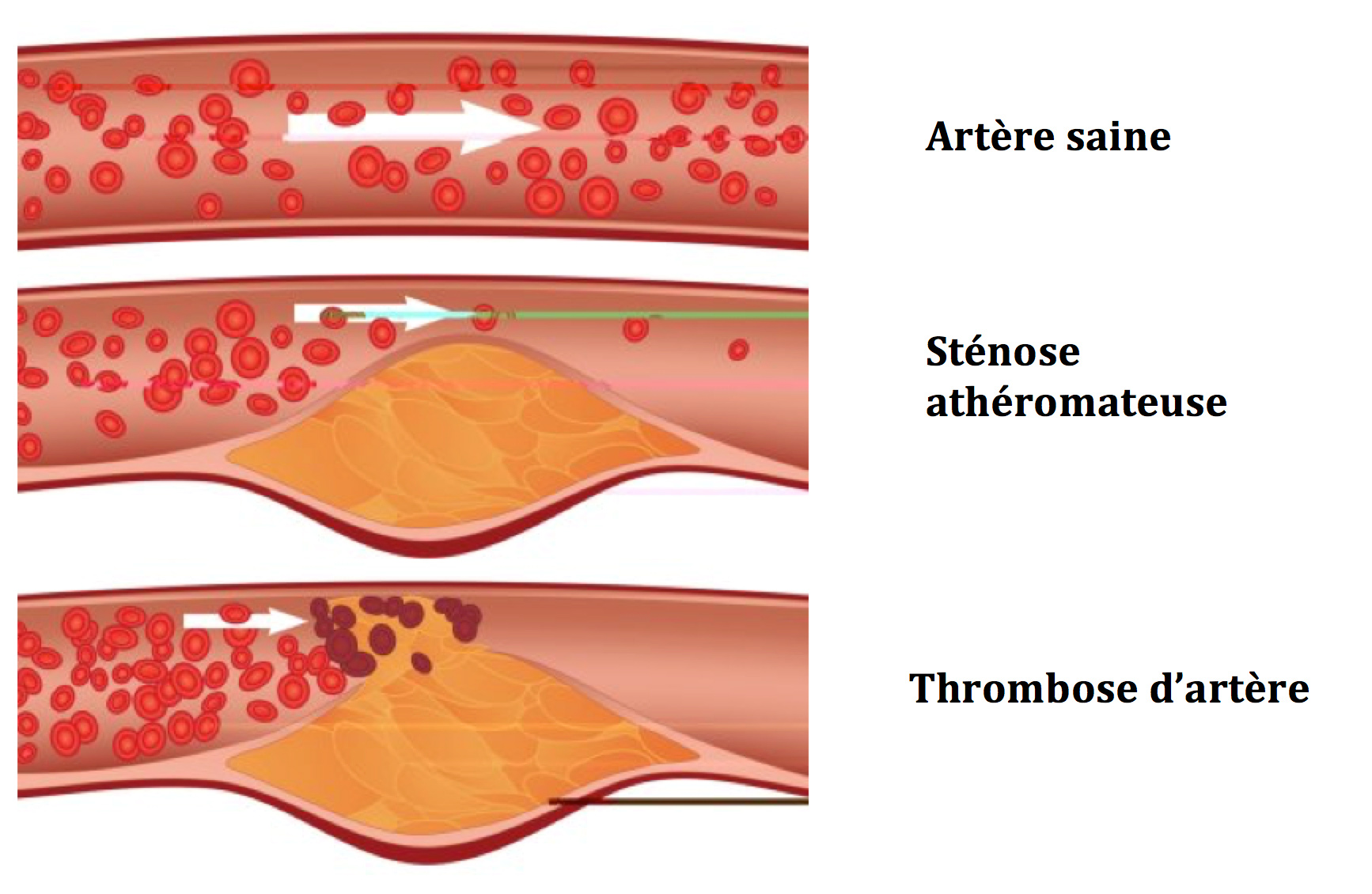 Définition Artériopathie