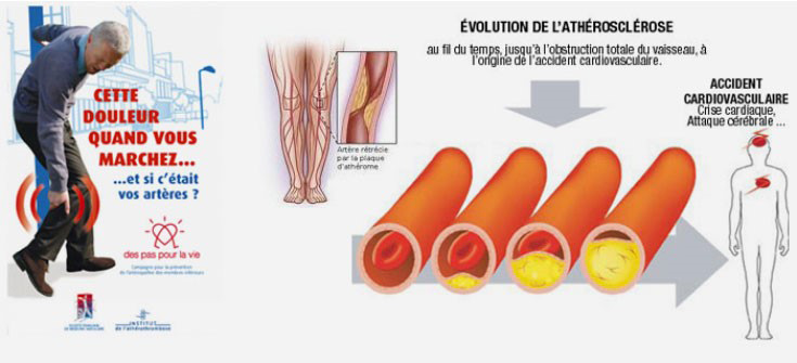 Indications de traitement Artériopathie