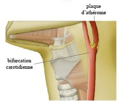 Physiopathologie artérielle