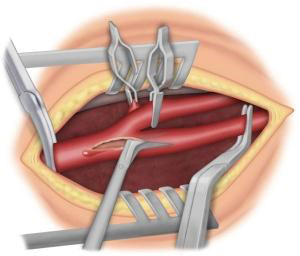 Chirurgie artérielle conventionnelle 69