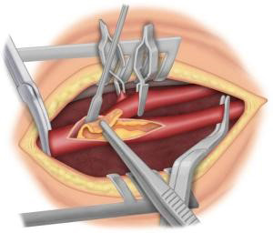 Chirurgie artérielle conventionnelle lyon