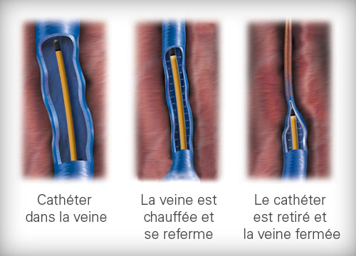 Symptômes Artériopathie - Diagnostic Artériopathie