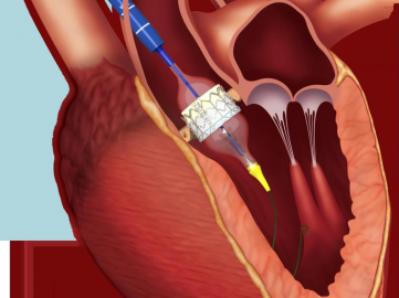 Implantation de valve transcatheter par voie transaortique - Registre ROUTE