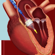 Implantation de valve transcatheter par voie transaortique - Registre ROUTE